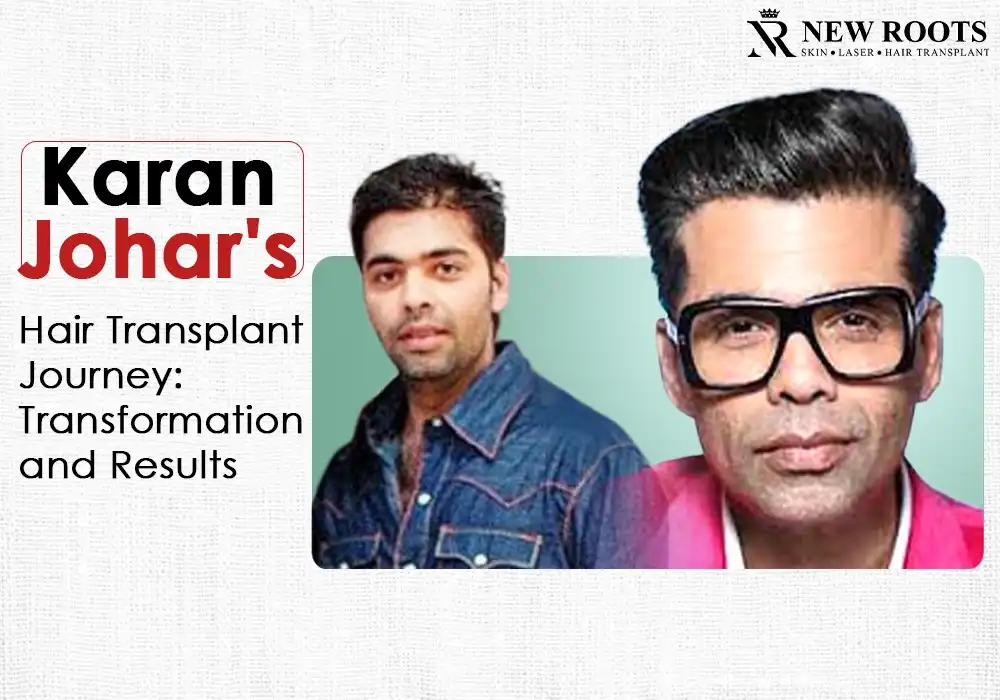 Karan Johar Hair Transplant