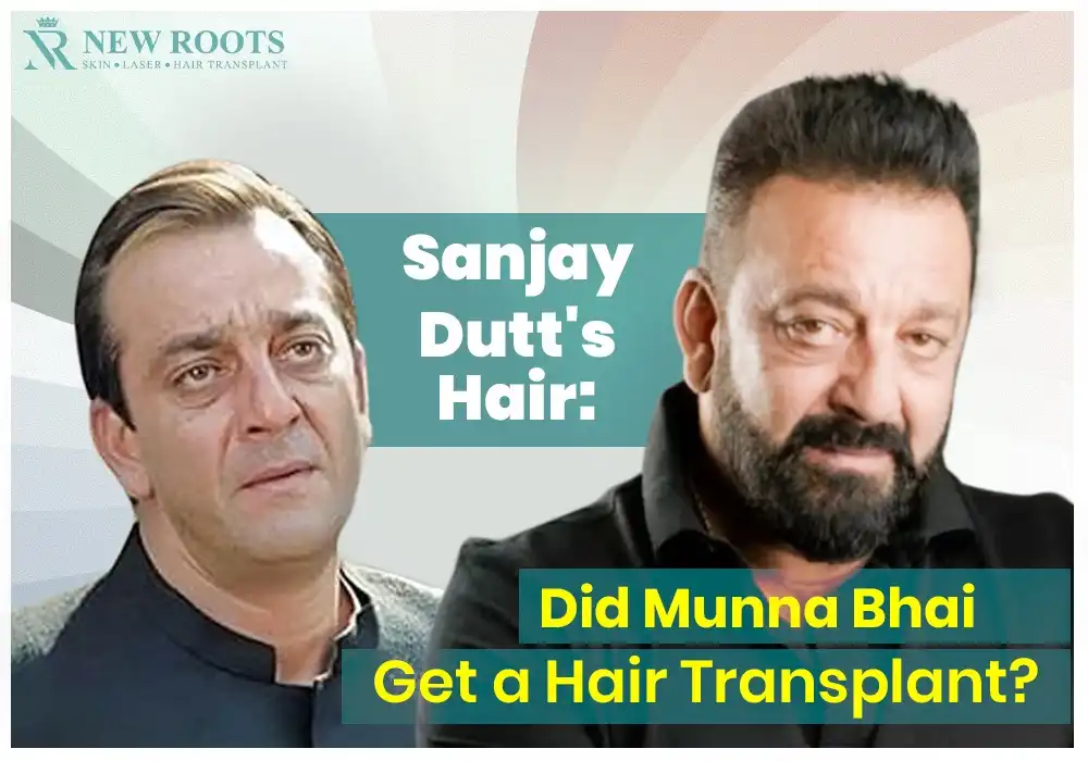 Sanjay Dutt hair transplant