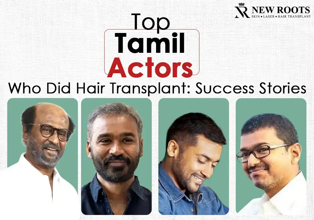 Tamil actors who did hair transplant