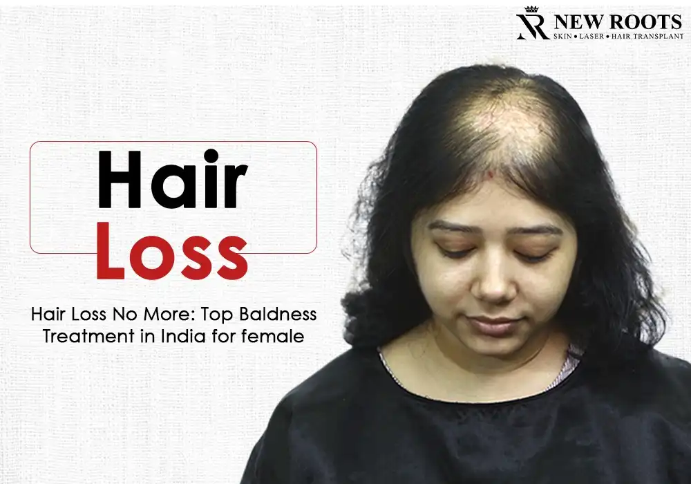 baldness treatment in India for female