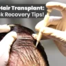 dhi hair transplant recovery time