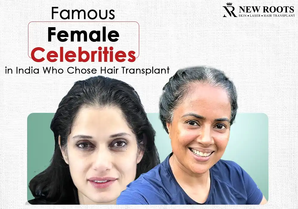hair transplant female celebrities in India