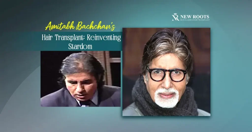 Amitabh Bachchan Hair Transplant