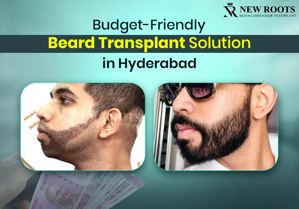 Beard Transplant Cost in Hyderabad