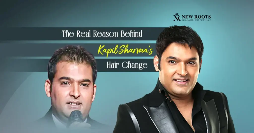 Kapil Sharma Hair Transplant