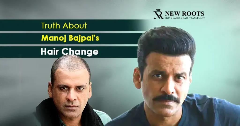 Manoj Bajpai hair transplant