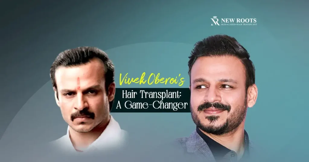 Vivek Oberoi hair transplant