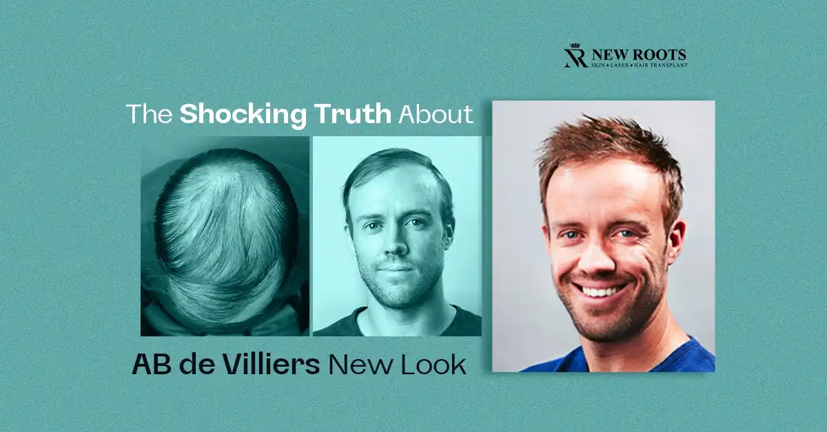 ab de Villiers hair transplant