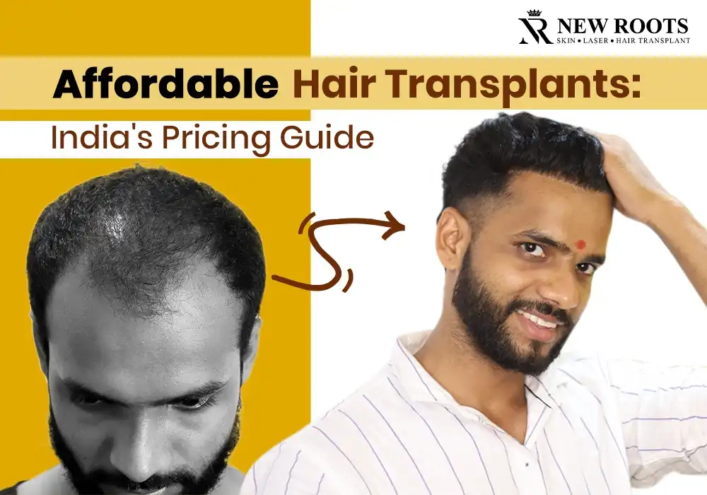 what is the price of a hair transplant in India?