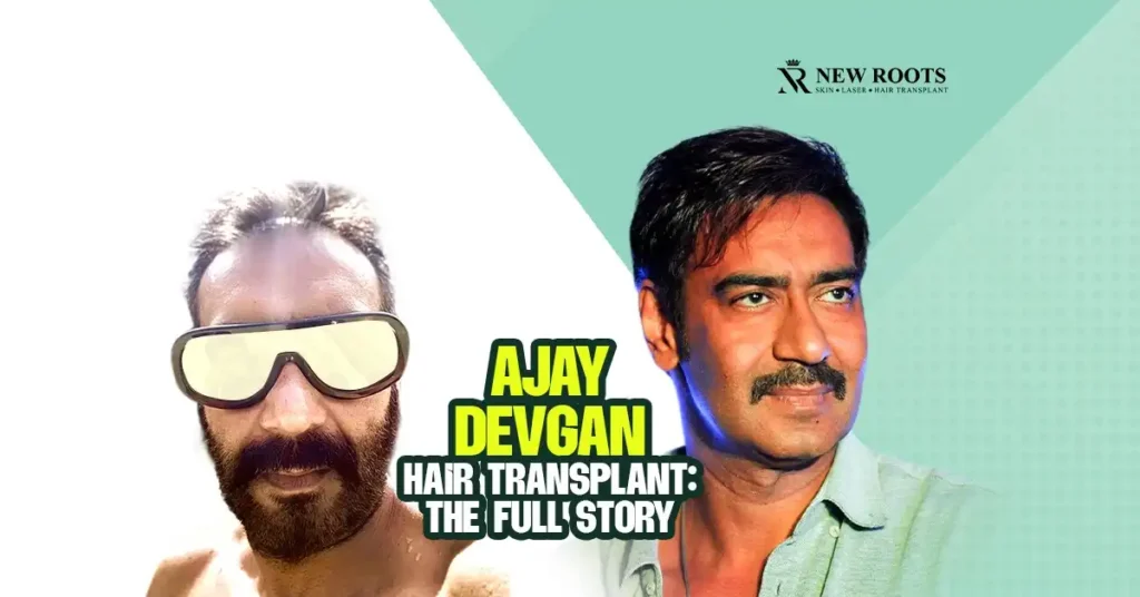 Ajay Devgan Hair Transplant