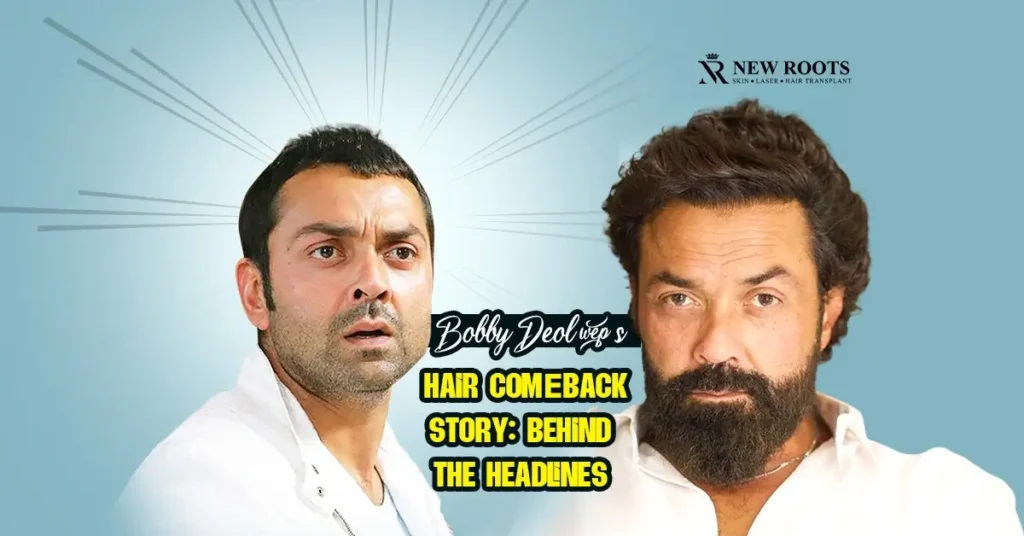 Bobby Deol Hair Transplant