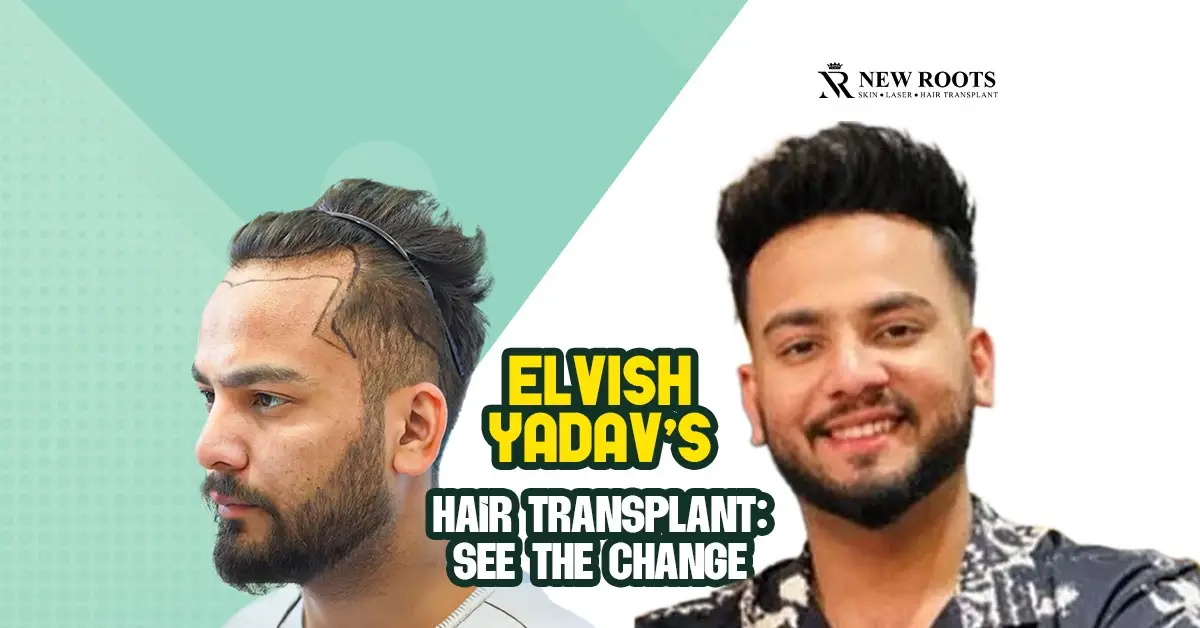 Elvish Yadav Hair Transplant