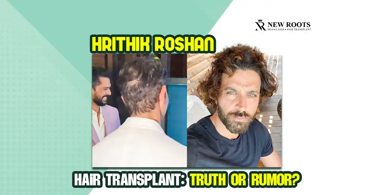 Hrithik Roshan hair transplant