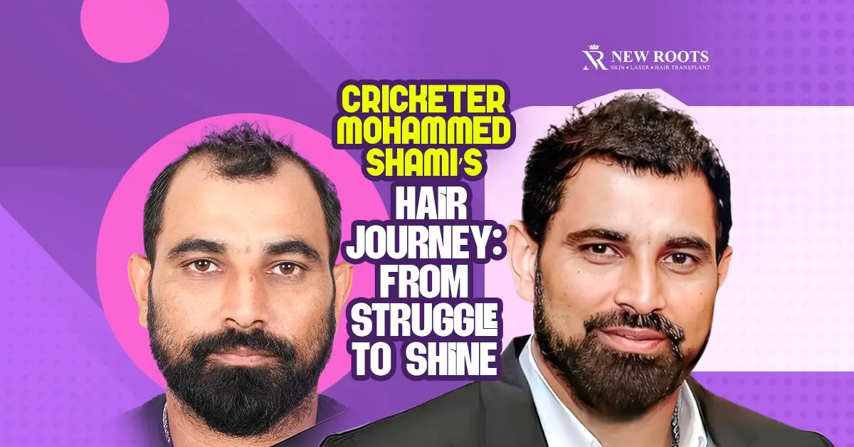 Mohammad Shami Hair Transplant