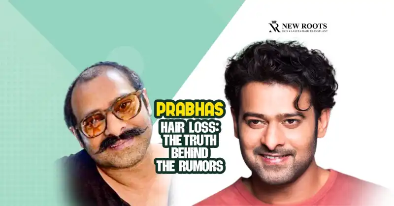 Prabhas hair loss