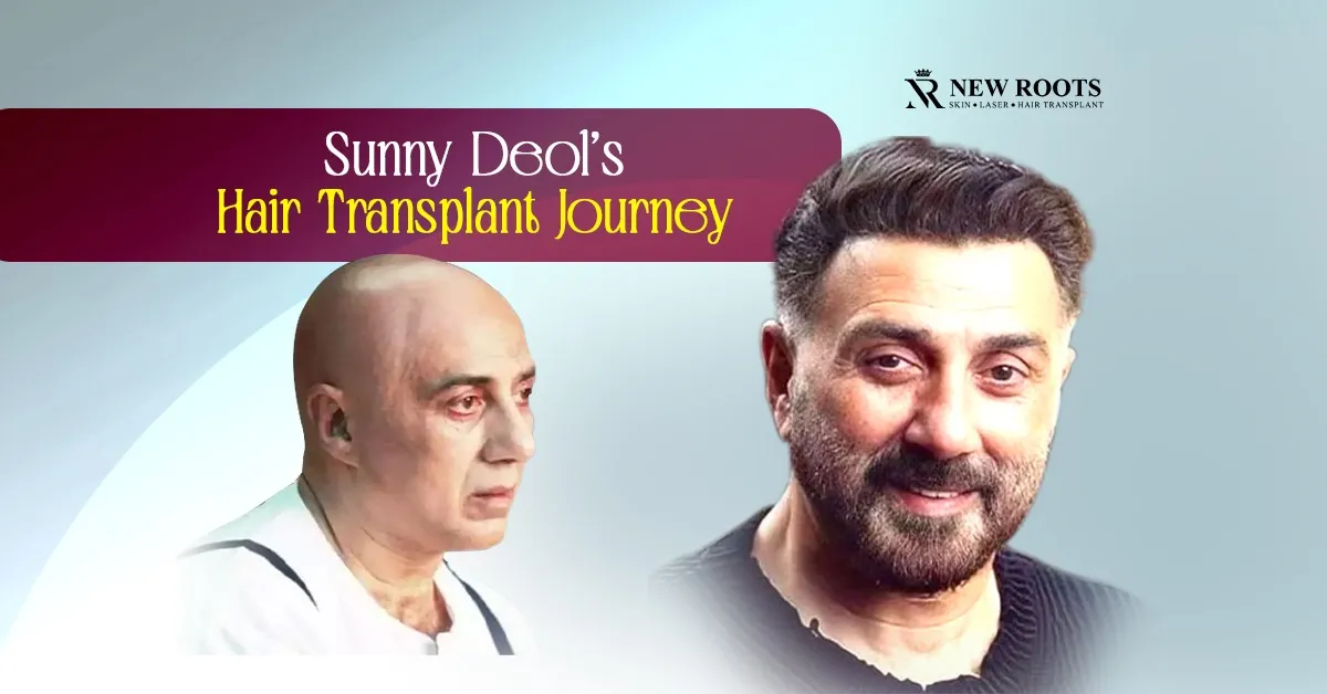 Sunny Deol Hair Transplant