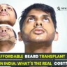 Beard Transplant Cost in India