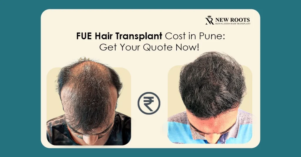 FUE Hair Transplant Cost in Pune