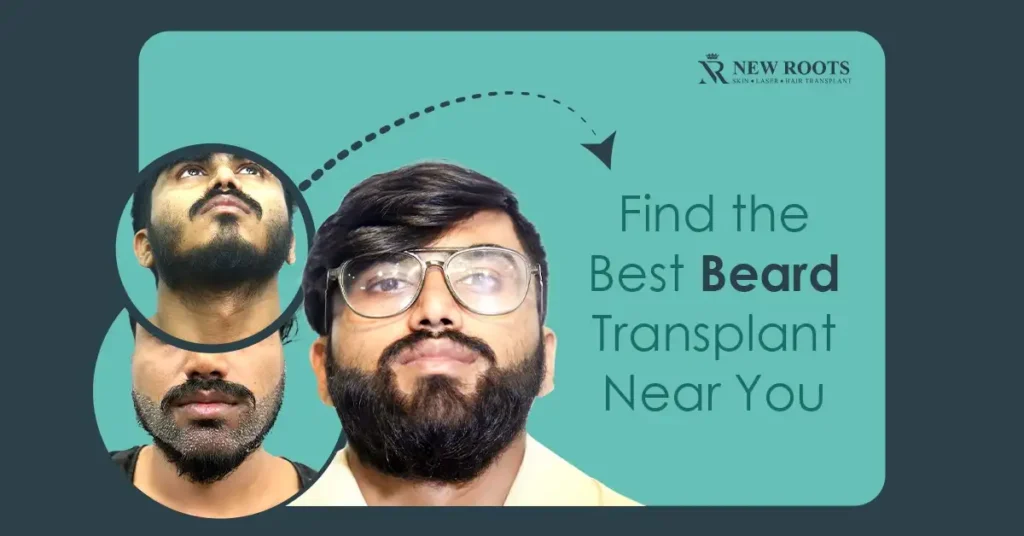 beard transplant near me