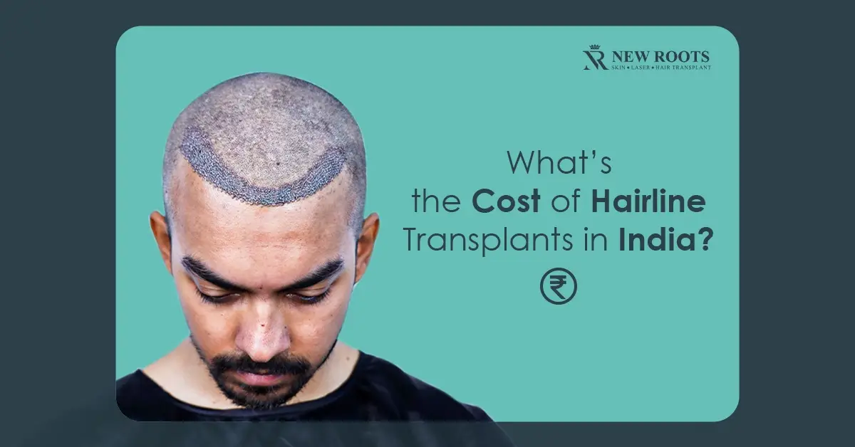 hairline transplant cost in India