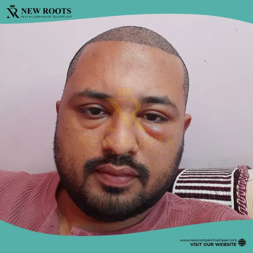 Swelling and Scabbing After a Hair Transplant