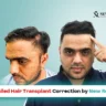 failed hair transplant correction + failed hair transplant repair