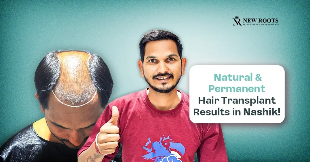 hair transplant results in Nashik