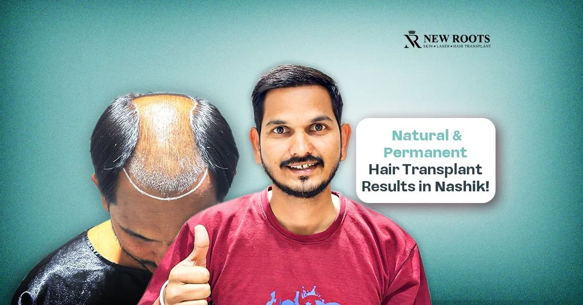 hair transplant results in Nashik