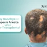 hair transplants help cure alopecia areata