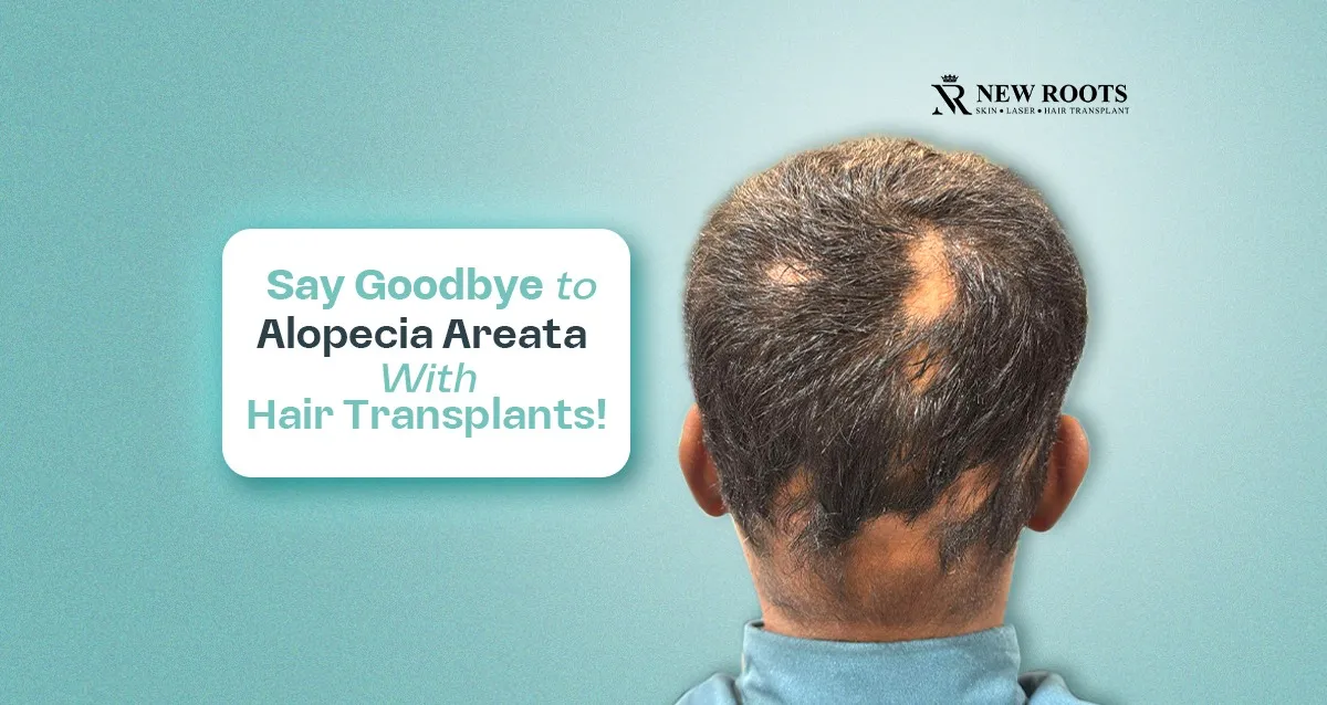 hair transplants help cure alopecia areata