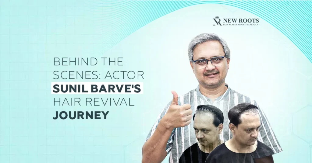 Actor Sunil Barve Hair Transplant Result