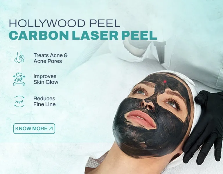 Carbon Laser Peel MV - Banner (NP)