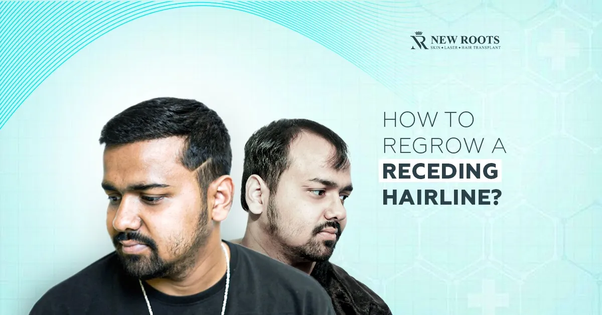 How to Regrow a Receding Hairline