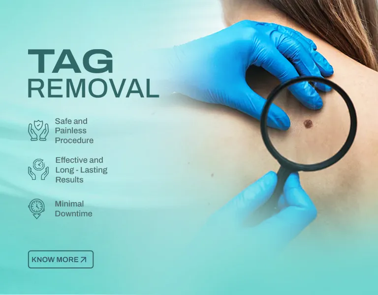 Tag Removal MV - Banner (NP)