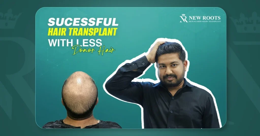 low donor area hair transplant