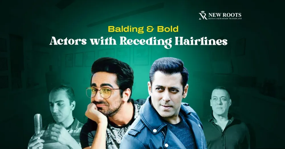 Actors with Receding Hairlines
