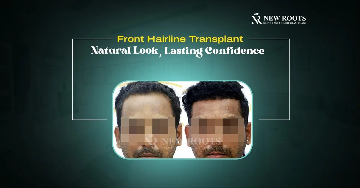 Front Hairline Transplant
