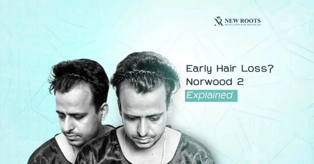 Norwood 2 hairline​