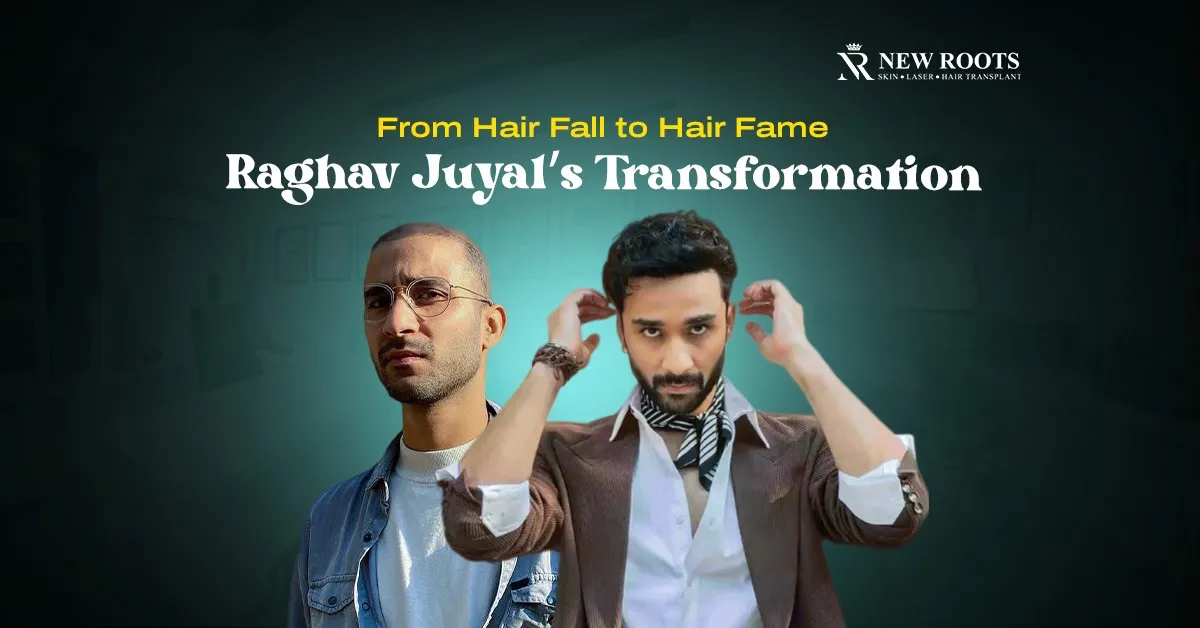 Raghav Juyal Hair Transplant
