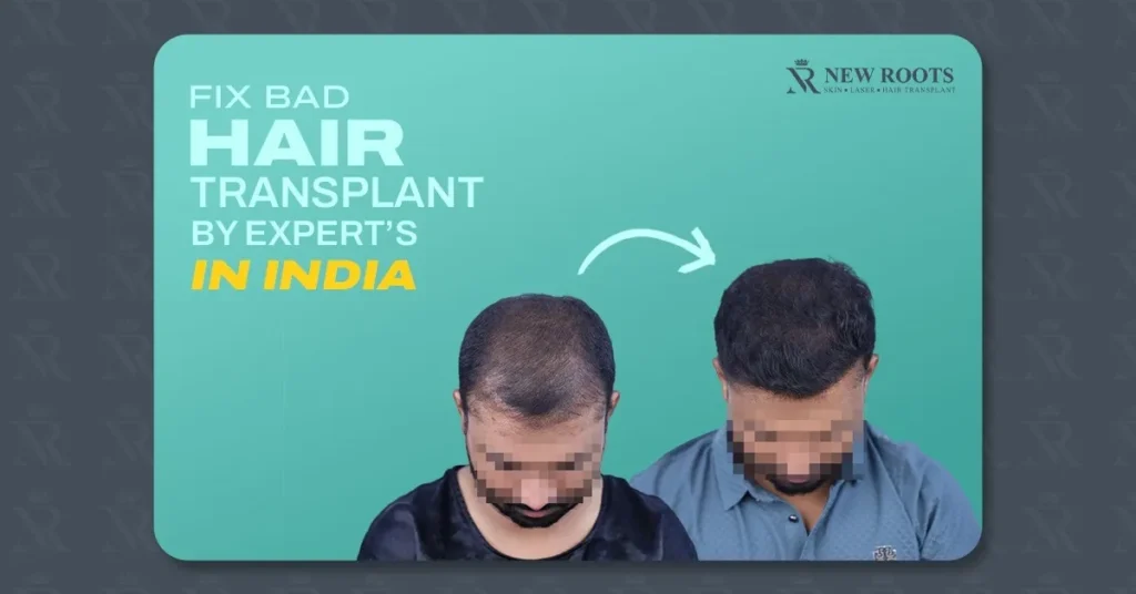 Revision Hair Transplant in India