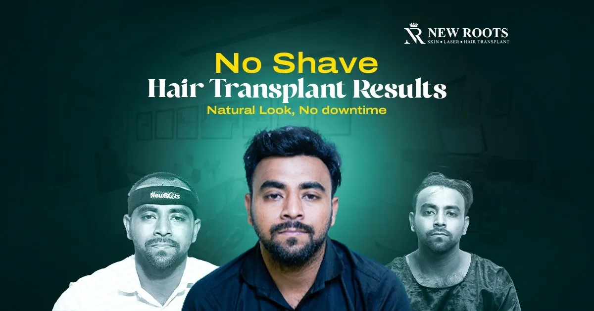 without shave hair transplant