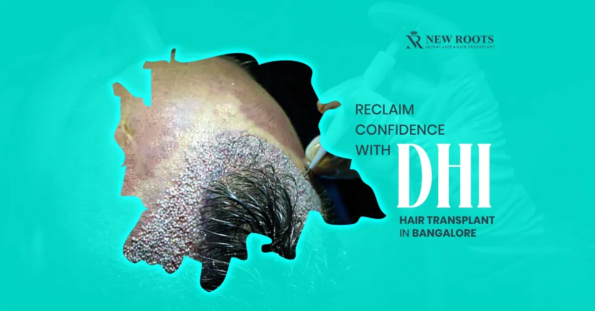 DHI Hair Transplant in Bangalore