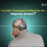 Does Hair Transplant Work For Alopecia Areata