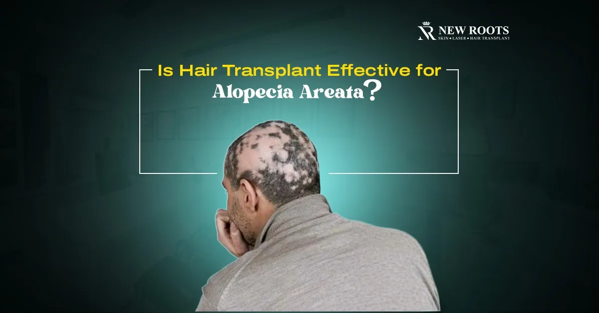 Does Hair Transplant Work For Alopecia Areata
