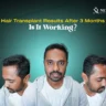 Hair Transplant Results After 3 Months