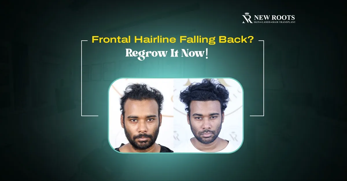 How to Regrow Frontal Hairline