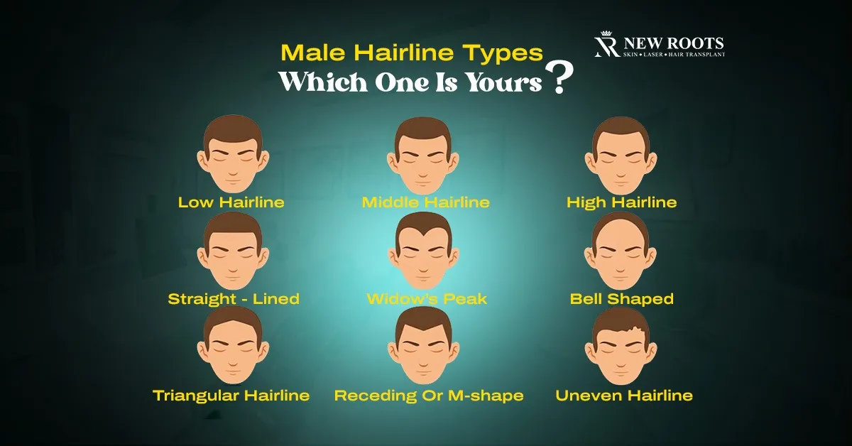 Male Hairline Types