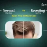 Normal Hairline vs Receding Hairline