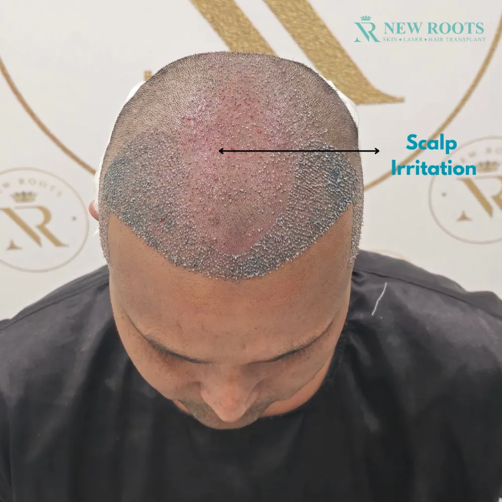 Scalp Sensitivity After Hair Transplant