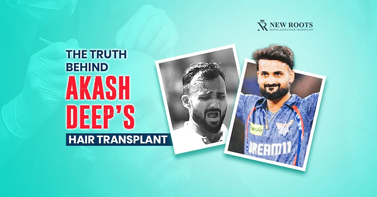 Akash Deep Hair Transplant